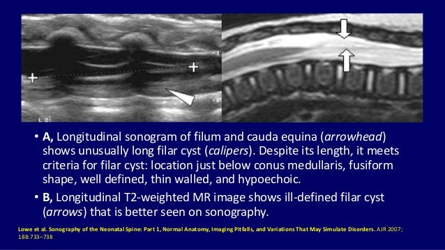 Ultrasound of spinal cord in neonates Dr. Muhammad Bin Zulfiqar