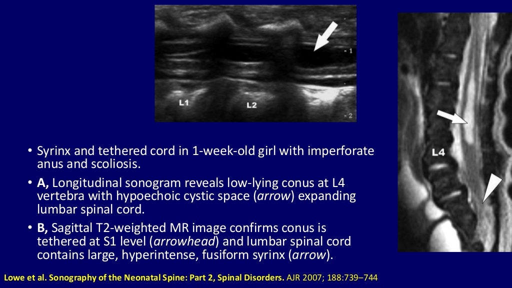 Ultrasound of spinal cord in neonates Dr. Muhammad Bin Zulfiqar