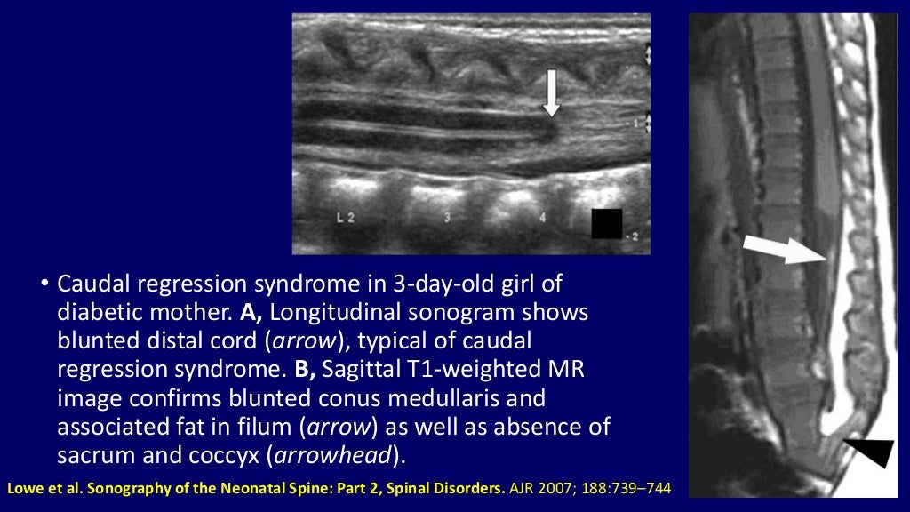 Ultrasound of spinal cord in neonates Dr. Muhammad Bin Zulfiqar