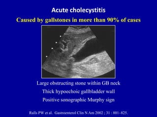 Ultrasound of the gallbladder | PPTX
