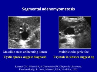 Adenomyomatosis Ultrasound