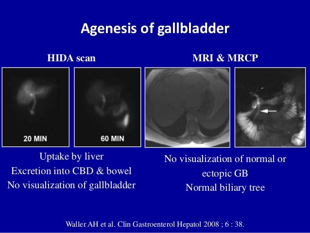 ultrasound of the gallbladder pipida scan full form