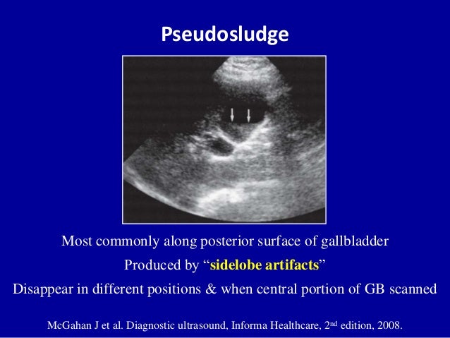 Ultrasound of the gallbladder