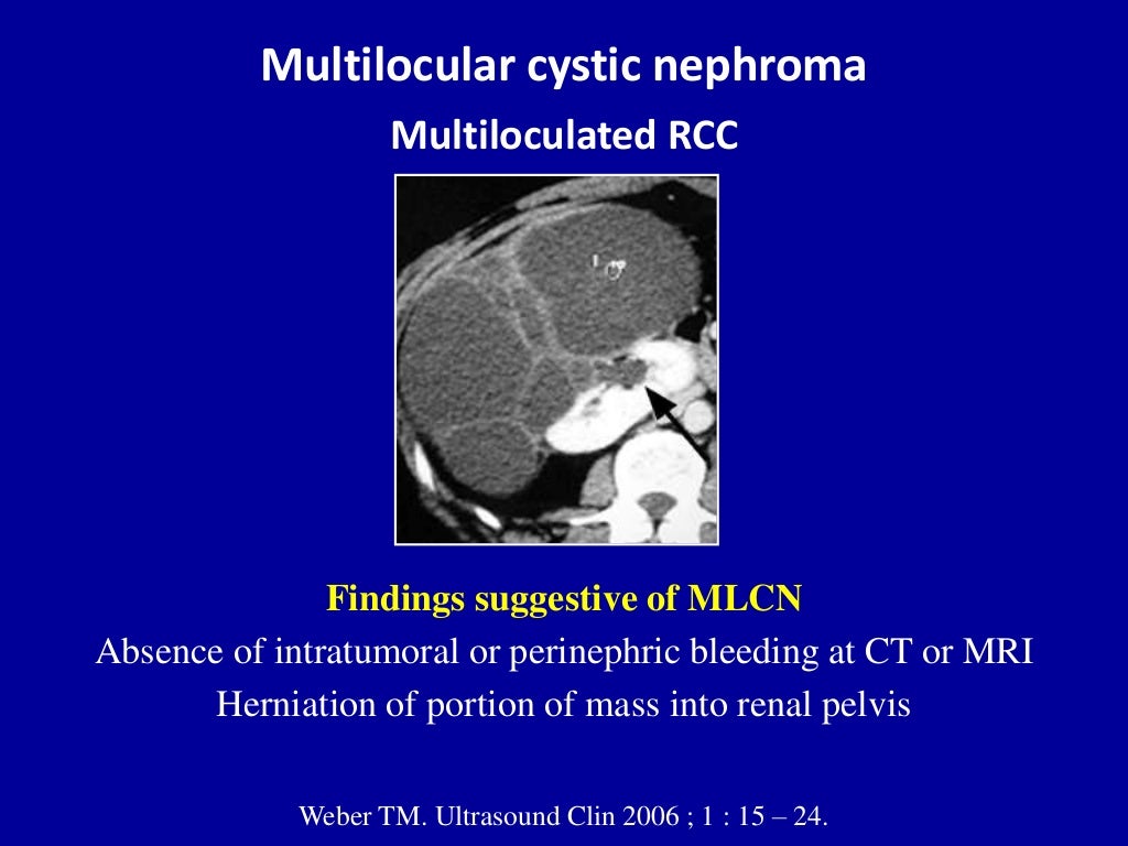 Ultrasound of the urinary tract Renal cysts