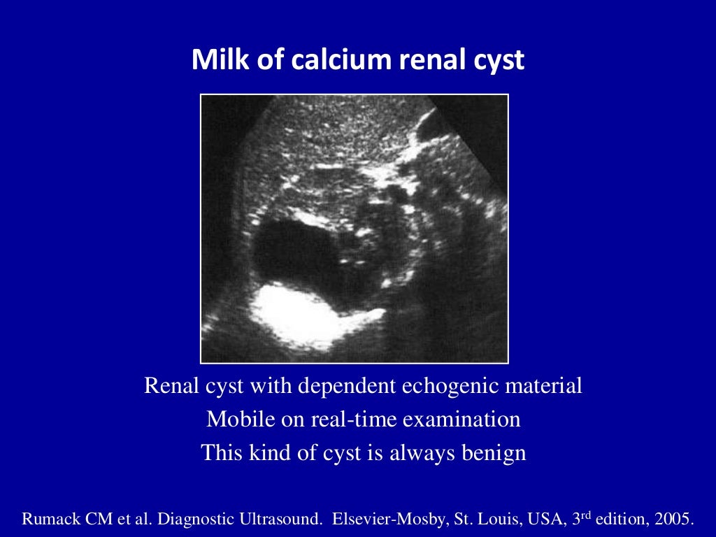 Ultrasound of the urinary tract Renal cysts