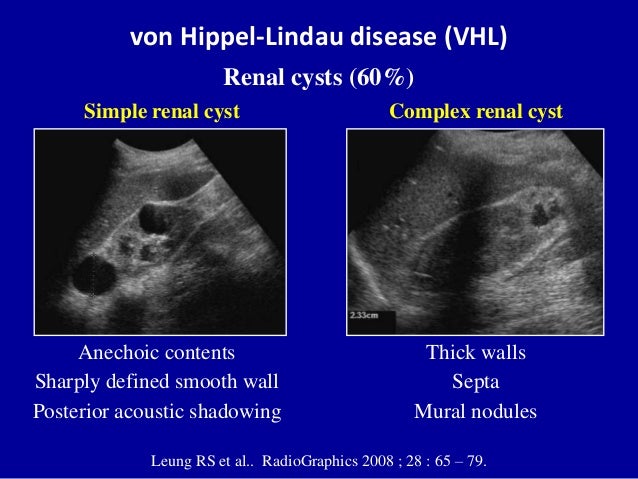 Ultrasound Of The Urinary Tract Renal Tumors