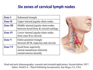 Six zones of cervical lymph nodes
Zone I Submental triangle
Zone II Upper internal jugular chain nodes
Zone III Middle int...