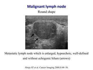 Ahuja AT et al. Cancer Imaging 2008;8:48–56.
Malignant lymph node
Round shape
Metastatic lymph node which is enlarged, hyp...