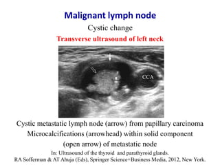 Malignant lymph node
Cystic change
In: Ultrasound of the thyroid and parathyroid glands.
RA Sofferman & AT Ahuja (Eds), Sp...