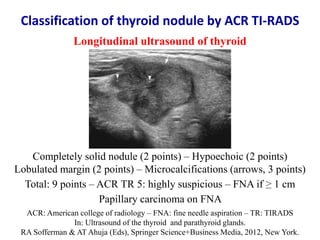 Longitudinal ultrasound of thyroid
Completely solid nodule (2 points) – Hypoechoic (2 points)
Lobulated margin (2 points) ...