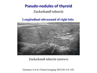 Pseudo-nodules of thyroid
Zuckerkandl tubercle
Germano A et al. Clinical imaging 2019;58:114–128.
Zuckerkandl tubercle (ar...
