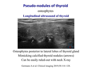 Pseudo-nodules of thyroid
osteophytes
Osteophytes posterior to lateral lobes of thyroid gland
Mimicking calcified thyroid ...