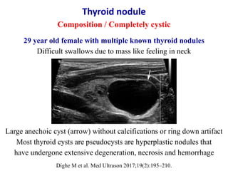 Large anechoic cyst (arrow) without calcifications or ring down artifact
Most thyroid cysts are pseudocysts are hyperplast...