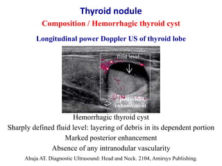 Ahuja AT. Diagnostic Ultrasound: Head and Neck. 2104, Amirsys Publishing.
Hemorrhagic thyroid cyst
Sharply defined fluid l...