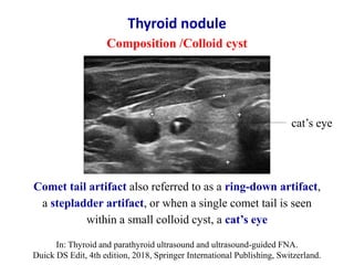 Thyroid nodule
Composition /Colloid cyst
Comet tail artifact also referred to as a ring-down artifact,
a stepladder artifa...