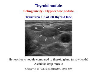 Thyroid nodule
Echogenicity / Hypoechoic nodule
Hypoechoeic nodule compared to thyroid gland (arrowheads)
Asterisk: strap ...