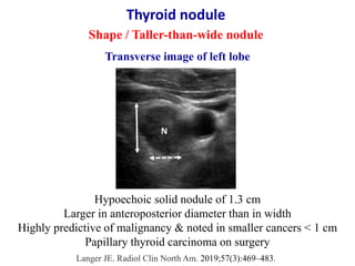 Thyroid nodule
Shape / Taller-than-wide nodule
Langer JE. Radiol Clin North Am. 2019;57(3):469–483.
Hypoechoic solid nodul...