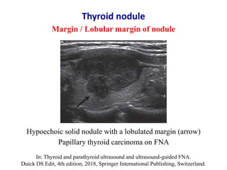 Hypoechoic solid nodule with a lobulated margin (arrow)
Papillary thyroid carcinoma on FNA
Thyroid nodule
Margin / Lobular...