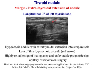 Thyroid nodule
Margin / Extra-thyroidal extension of nodule
Longitudinal US of left thyroid lobe
Hypoechoic nodule with ex...