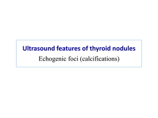 Ultrasound features of thyroid nodules
Echogenic foci (calcifications)
 