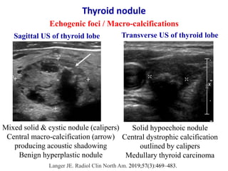 Thyroid nodule
Echogenic foci / Macro-calcifications
Langer JE. Radiol Clin North Am. 2019;57(3):469–483.
Mixed solid & cy...