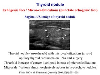 Sagittal US image of thyroid nodule
Thyroid nodule (arrowheads) with micro-calcifications (arrow)
Papillary thyroid carcin...