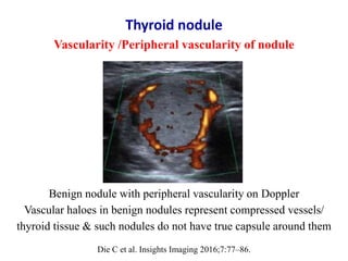 Benign nodule with peripheral vascularity on Doppler
Vascular haloes in benign nodules represent compressed vessels/
thyro...
