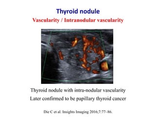 Thyroid nodule
Vascularity / Intranodular vascularity
Die C et al. Insights Imaging 2016;7:77–86.
Thyroid nodule with intr...