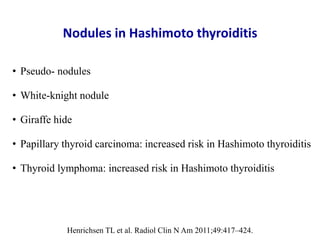 Nodules in Hashimoto thyroiditis
• Pseudo- nodules
• White-knight nodule
• Giraffe hide
• Papillary thyroid carcinoma: inc...