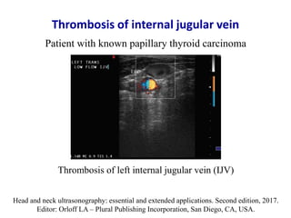 Thrombosis of internal jugular vein
Patient with known papillary thyroid carcinoma
Thrombosis of left internal jugular vei...