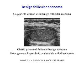 Benign follicular adenoma
Classic pattern of follicular benign adenoma
Homogeneous hypoechoic oval nodule with thin capsul...