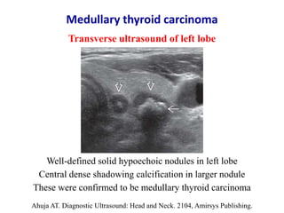 Medullary thyroid carcinoma
Ahuja AT. Diagnostic Ultrasound: Head and Neck. 2104, Amirsys Publishing.
Transverse ultrasoun...