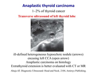 ill-defined heterogeneous hypoechoic nodule (arrows)
encasing left CCA (open arrow)
Anaplastic carcinoma on histology
Extr...