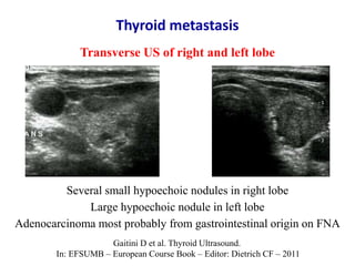 Transverse US of right and left lobe
Several small hypoechoic nodules in right lobe
Large hypoechoic nodule in left lobe
A...