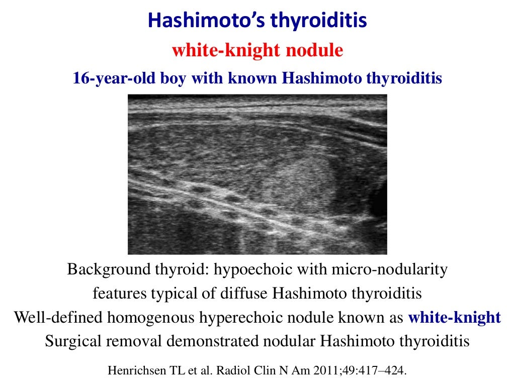 Hashimoto's Thyroiditis Ultrasound