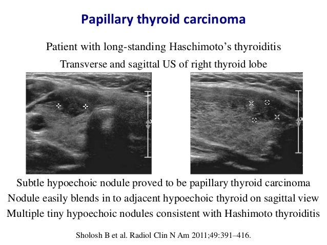What Does Hypoechoic Thyroid Nodule Mean Slide Share
