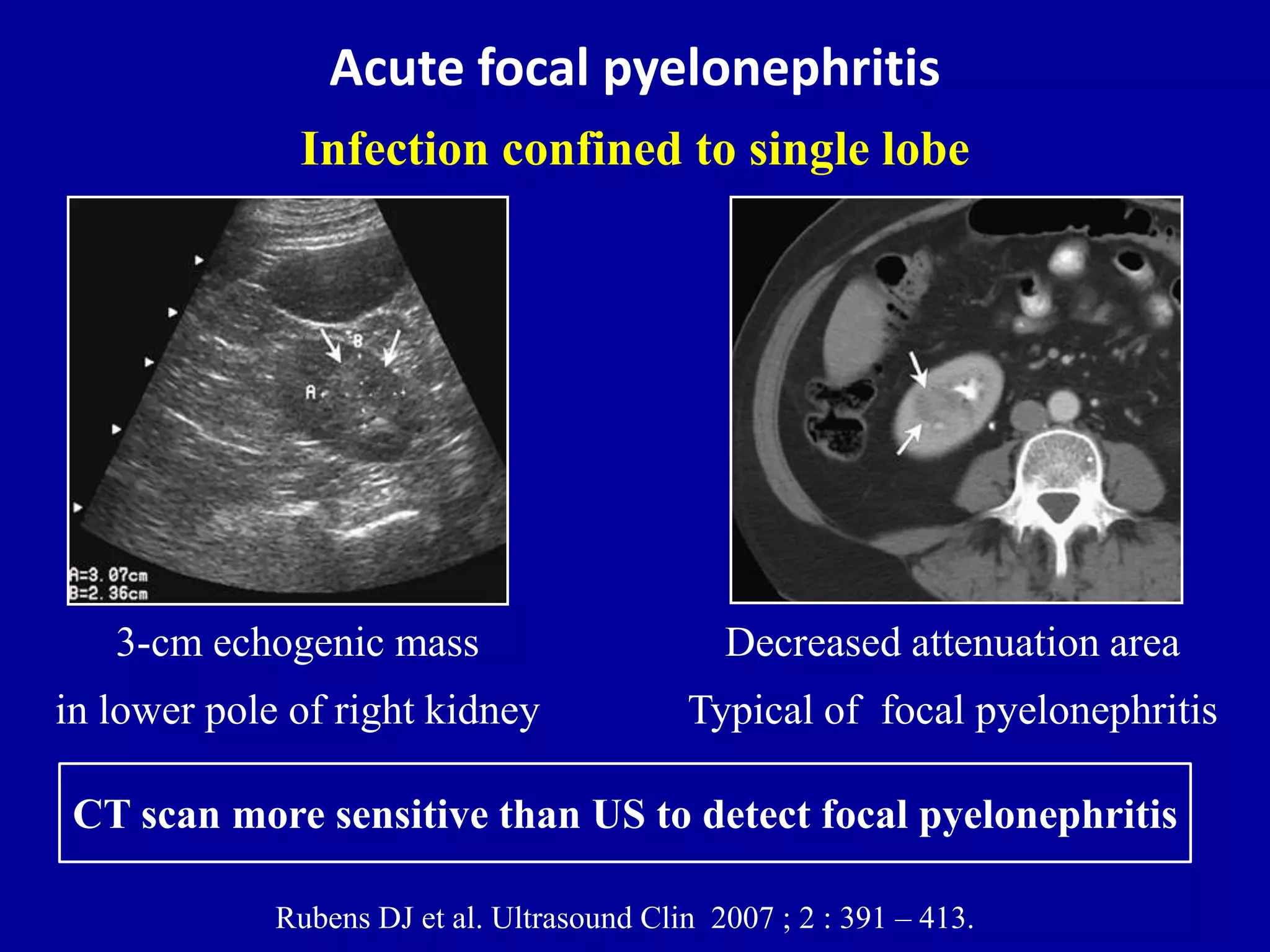 Ultrasound of the urinary tract - Renal infections | PPTX