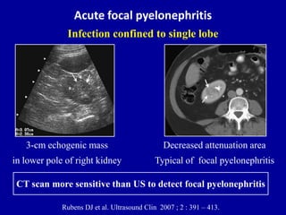 Pyelonephritis Ultrasound Kidney