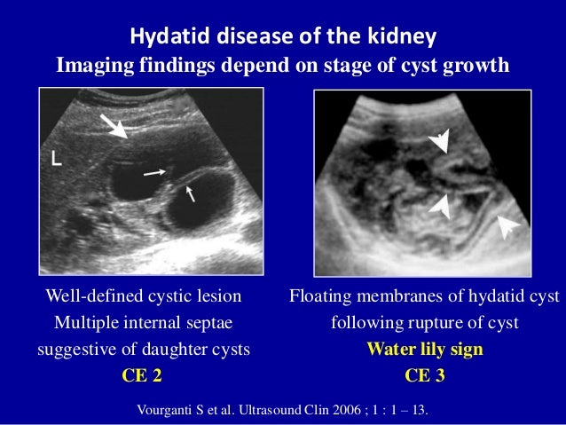 ultrasound of the urinary tract renal infections