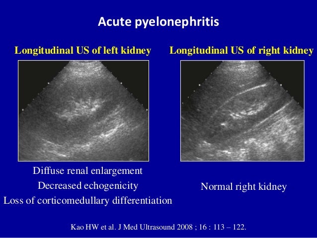 Image result for acute pyelonephritis image