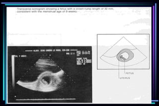 ultra sound O&Gy guide.ppt