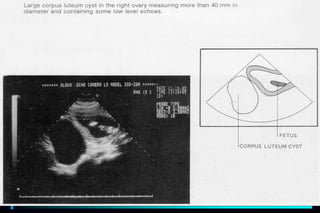 ultra sound O&Gy guide.ppt