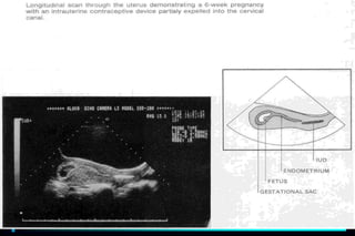 ultra sound O&Gy guide.ppt