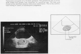 ultra sound O&Gy guide.ppt