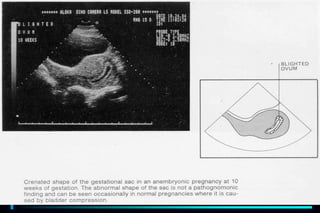 ultra sound O&Gy guide.ppt