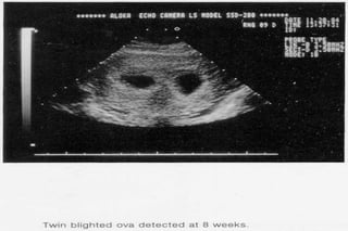 ultra sound O&Gy guide.ppt