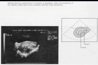 ultra sound O&Gy guide.ppt