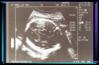 ultra sound O&Gy guide.ppt