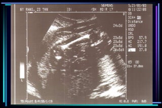 ultra sound O&Gy guide.ppt