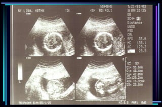 ultra sound O&Gy guide.ppt